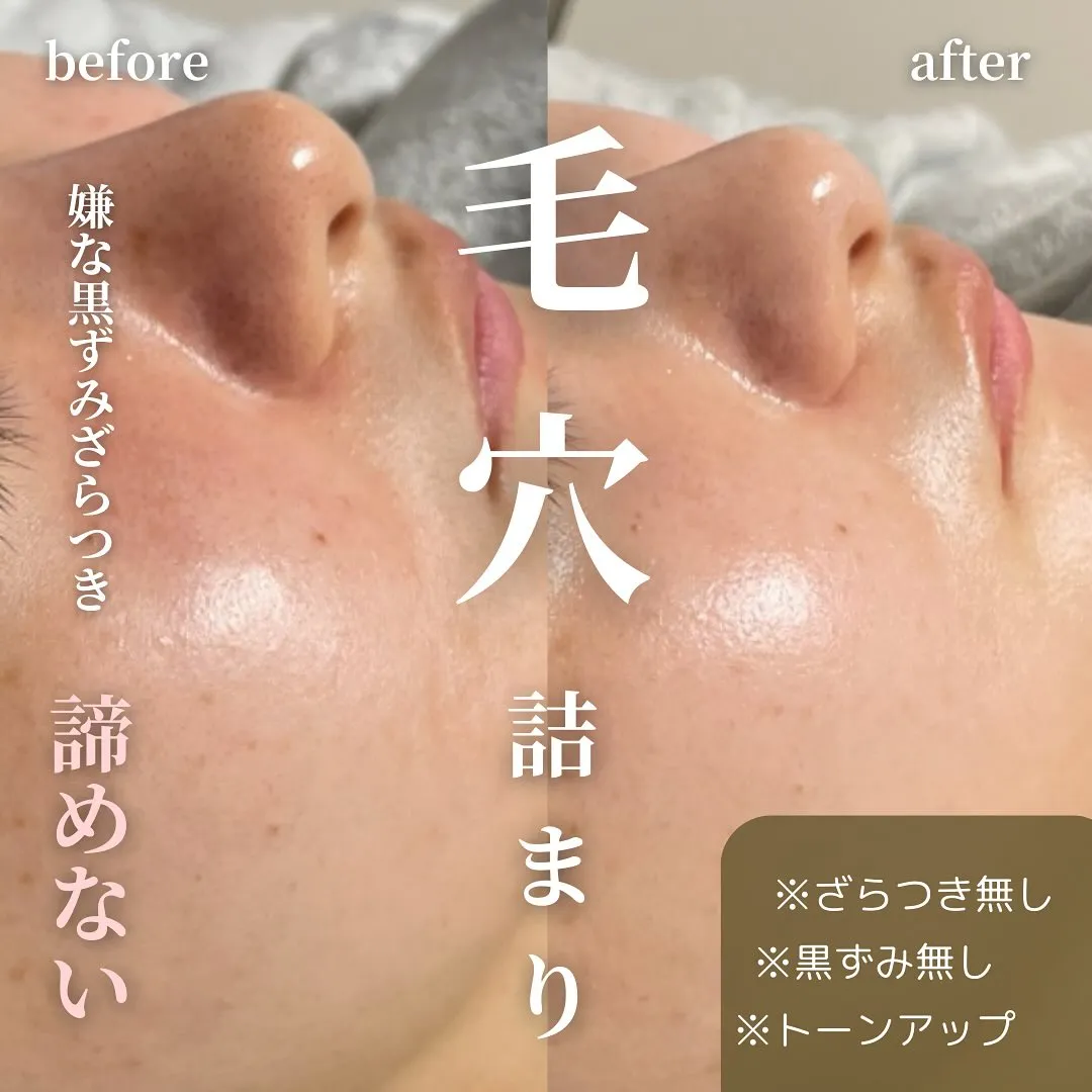 仙台フェイシャル　毛穴ケア