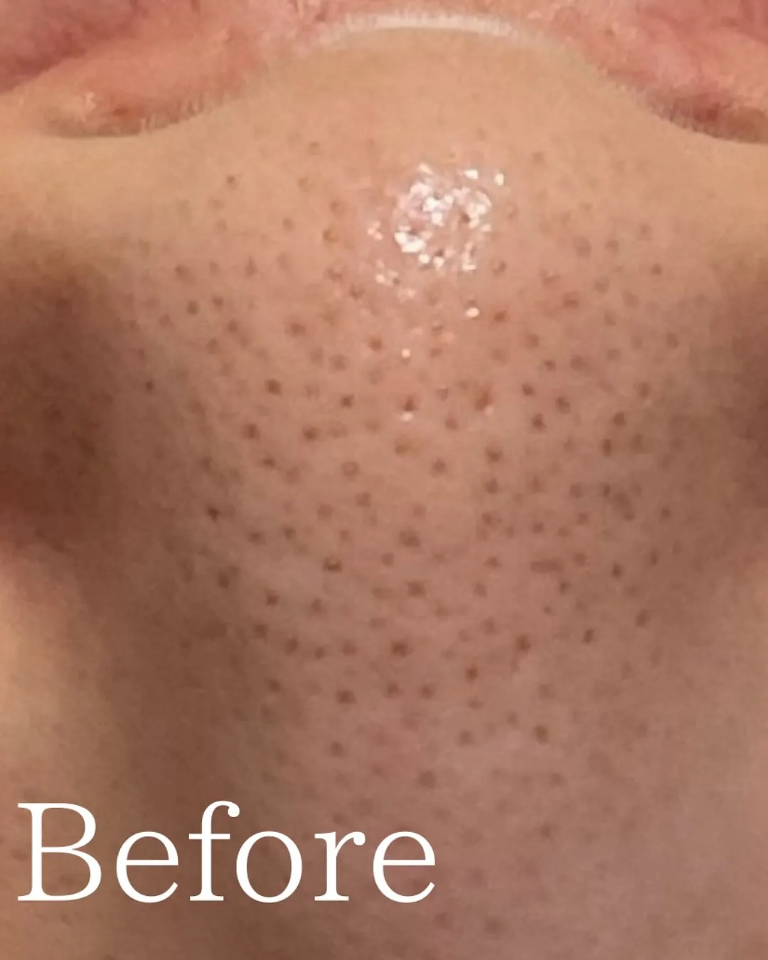 仙台フェイシャル　毛穴ケア