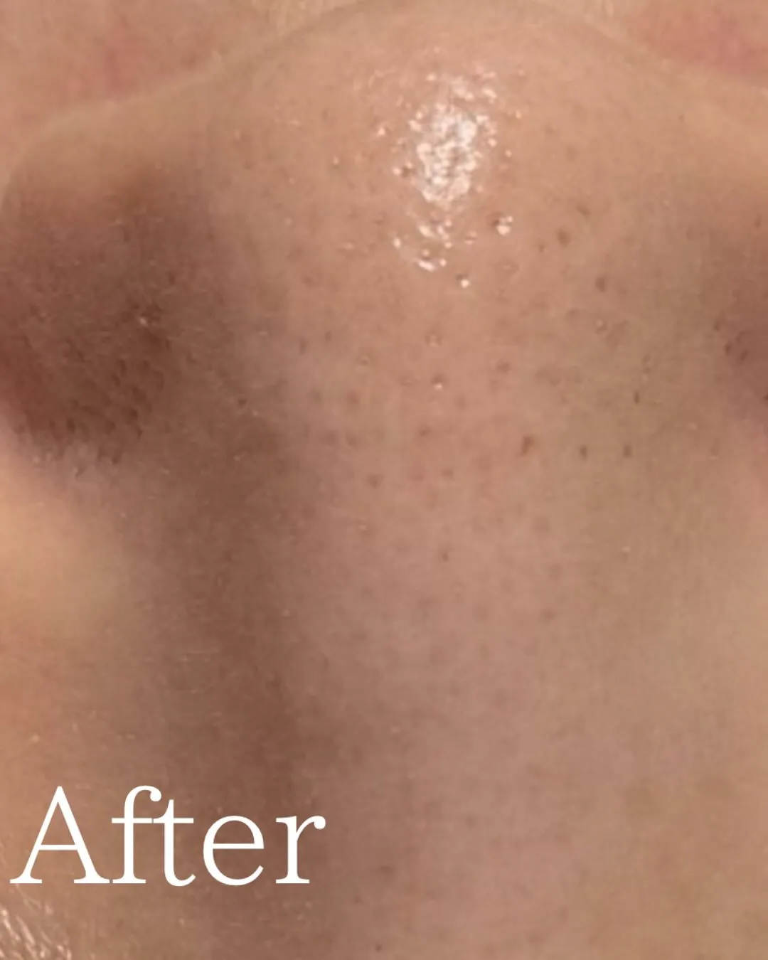 仙台フェイシャル　毛穴ケア