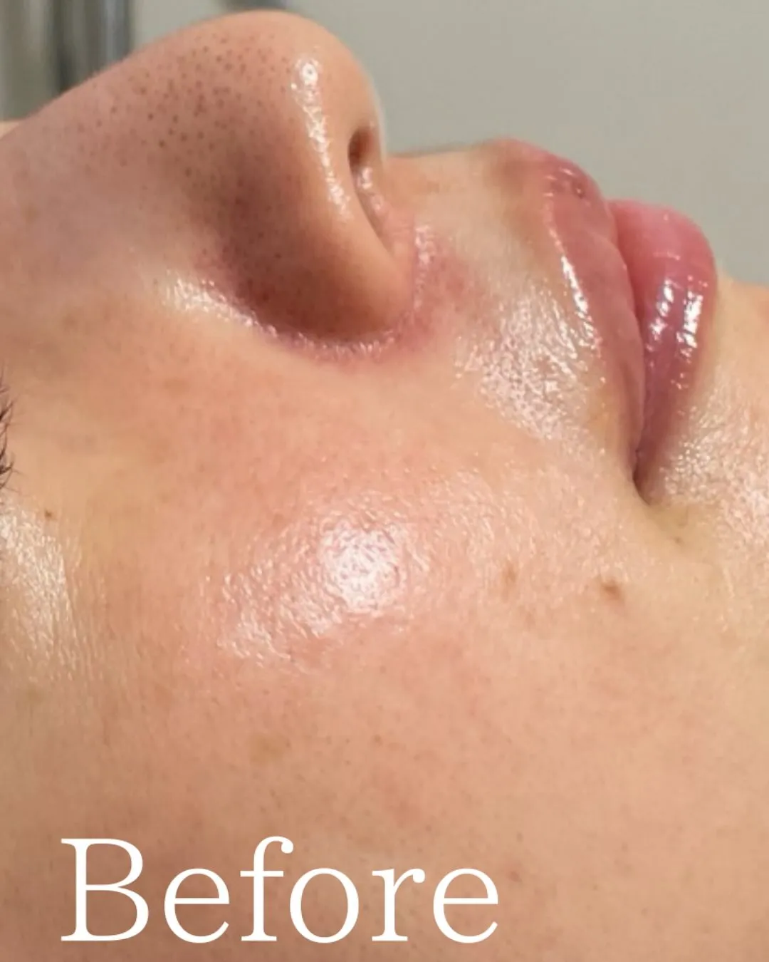 仙台フェイシャル　毛穴ケア